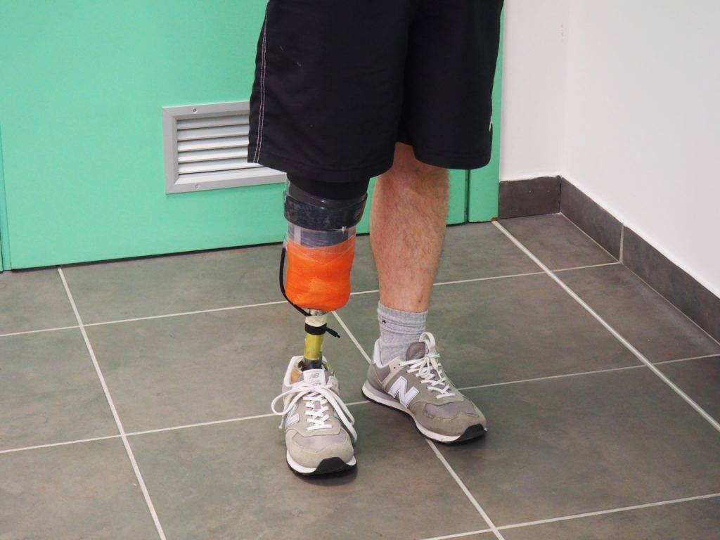 OTR Ortopedia - Ottobock - Consegna protesi arto inferiore - Protesi transfemorale a tenuta ipobarica