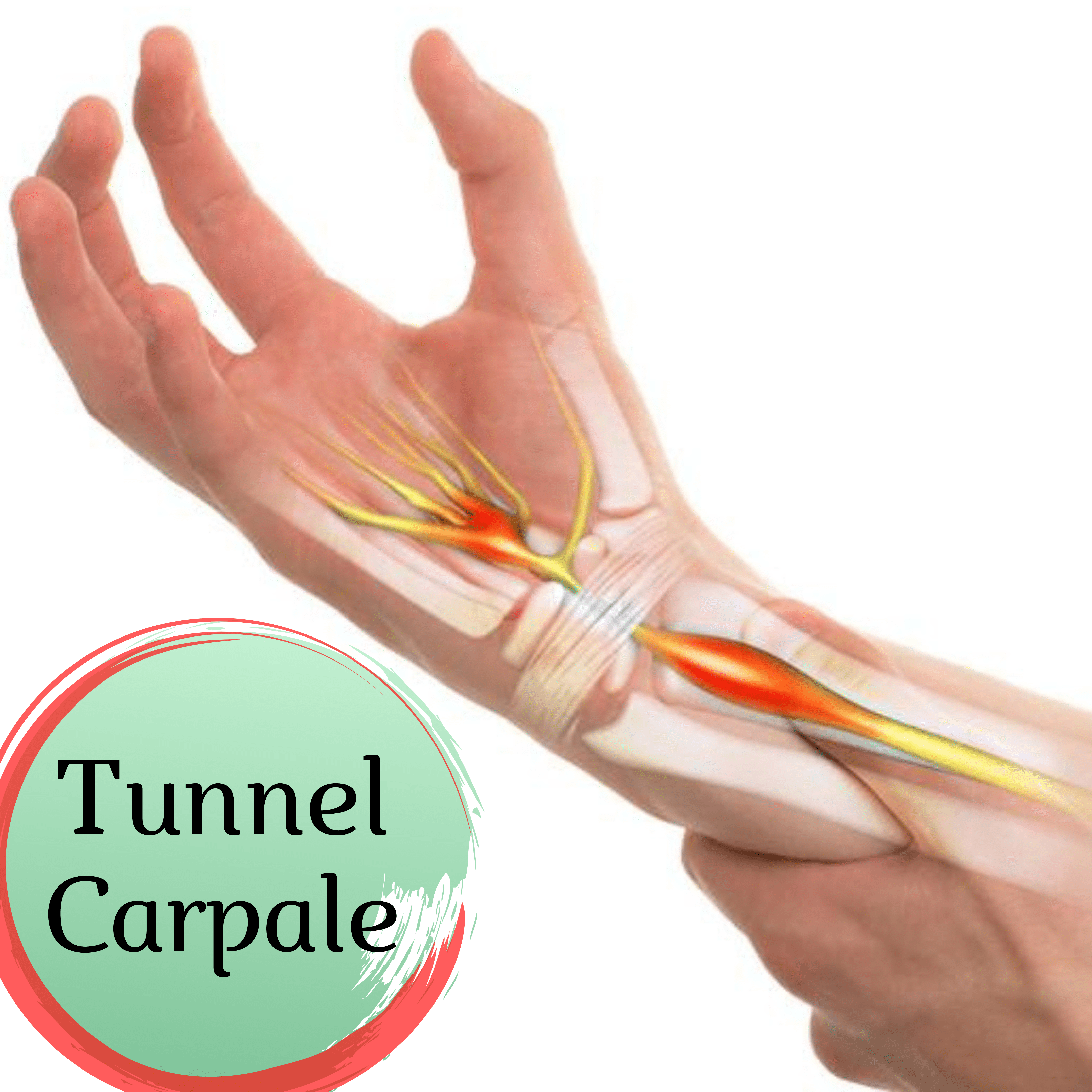 OTR Ortopedia - Tunnel carpale - Dr. Gibaud