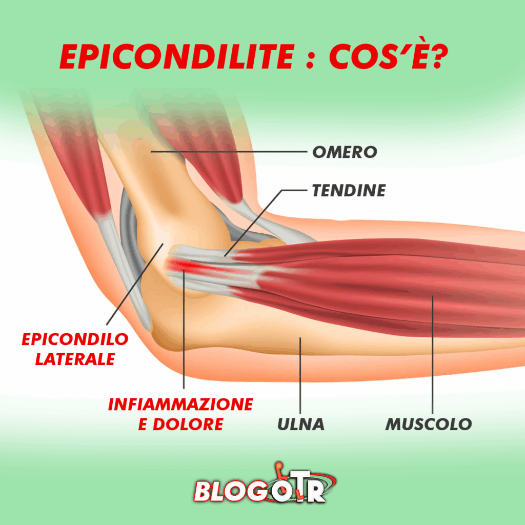 padel-ed-epicondilite