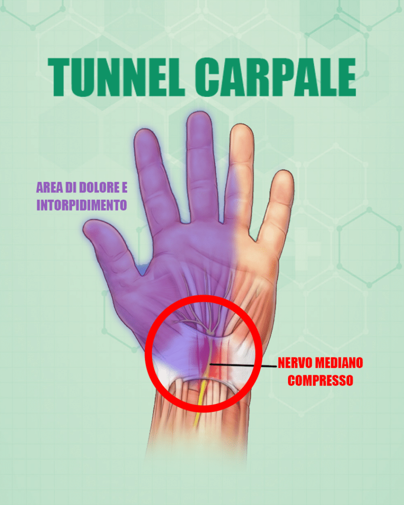 tunnel-carpale-gaming