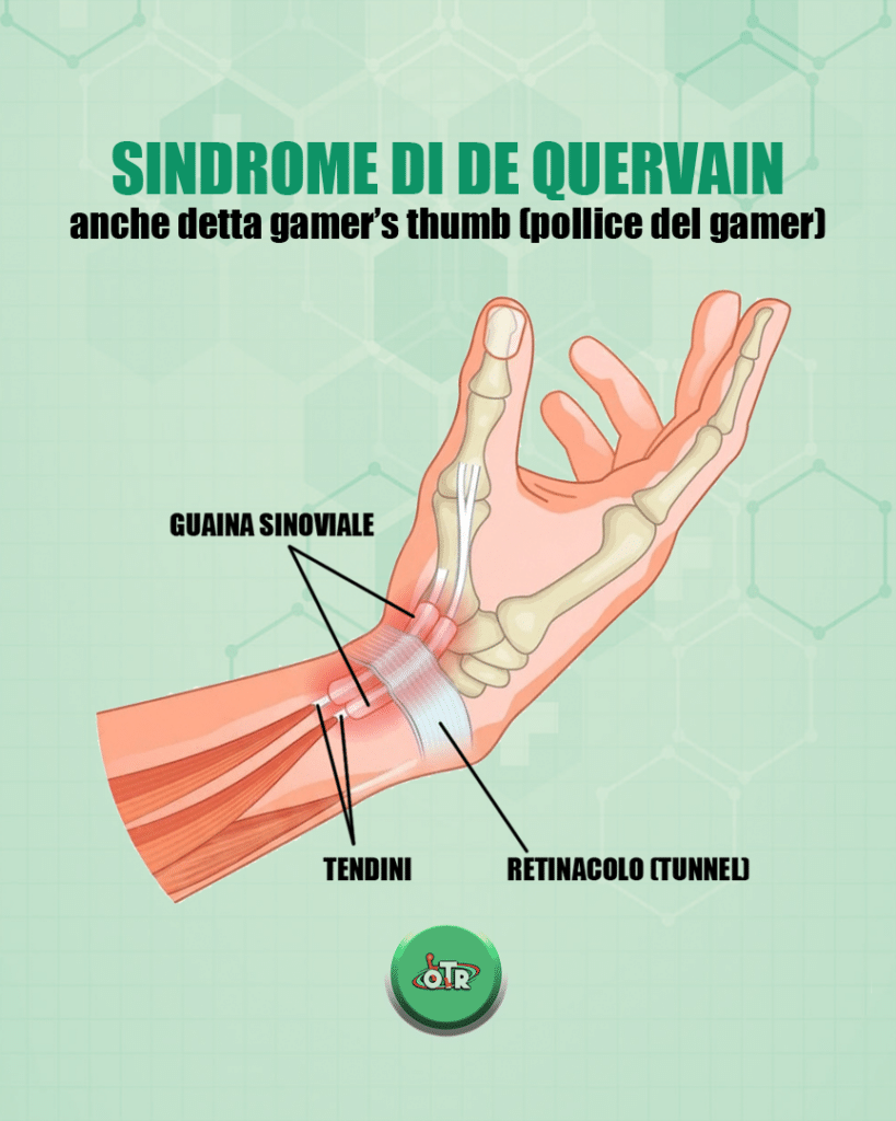 sindrome-de-quervain-gaming-otr